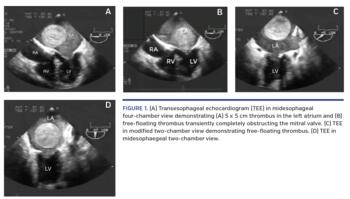 (A) Transesophageal echocardiogram (TEE) in midesophageal four-chamber view demonstrating (A) 5 x 5 cm thrombus in the left atrium and (B) free-floating thrombus transiently completely obstructing the mitral valve. (C) TEE in modified two-chamber view demonstrating free-floating thrombus. (D) TEE in midesophaegeal two-chamber view.