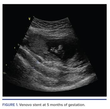 Venovo stent at 5 months of gestation.