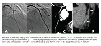 (A) Coronary angiography showed 90% tubular bifurcation lesion (Medina 1,0,0) of the mid LAD, which had (B) TIMI 3 flow following BVS deployment. (C) CT coronary angiography in curved reformatted view showed good opacification of the entire LAD, while (D) non-contrast CT showed two radiopaque stent markers of the BVS (white arrows) in the LAD.