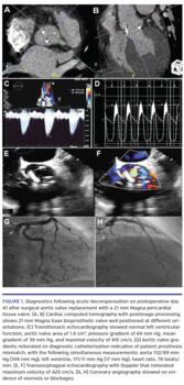 Diagnostics following acute decompensation
