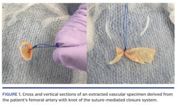 Cross and vertical sections of an extracted vascular specimen