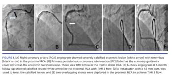 Right coronary artery (RCA) angiogram