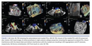 Color 3D-TEE showing the anterolateral and medial PVLs
