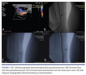 Ultrasonography demonstrating the pseudoaneurysm