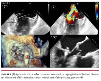 Figure 1. (A) A prolaptic mitral valve tissue and severe mitral regurgitation in Barlow’s disease. (B) Placement of first NTR clip at most medial part of the prolapse.