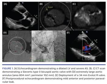 Echocardiogram demonstrating a dilated LV and severe AS