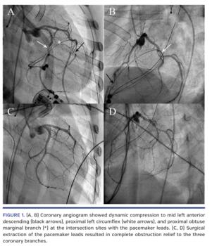 Coronary angiogram
