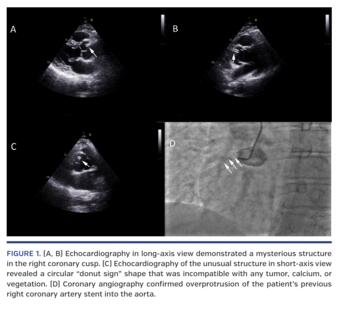 Echocardiography in long-axis view demonstrated a mysterious structure in the right coronary cusp. (