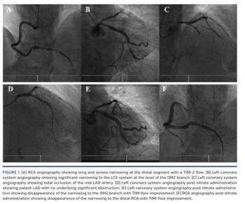 RCA angiography showing long and severe narrowing at the distal segment with a TIMI 2 flow.
