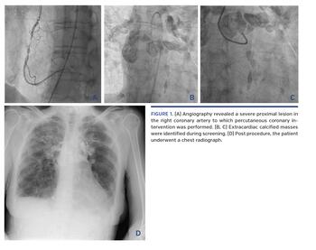 Angiography revealed a severe proximal lesion in the right coronary artery to which percutaneous coronary intervention was performed.