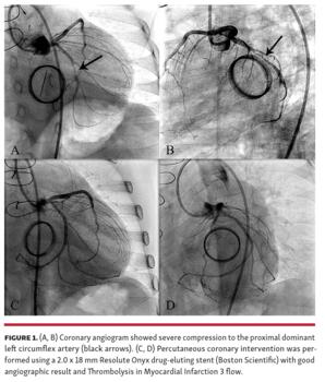 Figure 1. (A, B) Coronary angiogram showed severe compression to the proximal dominant left circumflex artery (black arrows). (C, D) Percutaneous coronary intervention was performed using a 2.0 x 18 mm Resolute Onyx drug-eluting stent (Boston Scientific) with good angiographic result and Thrombolysis in Myocardial Infarction 3 flow.