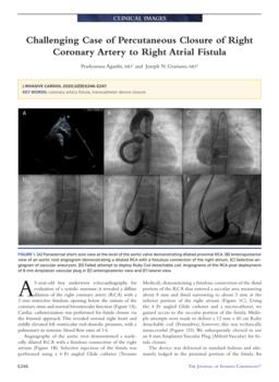 Parasternal short-axis view at the level of the aortic valve demonstrating dilated proximal RCA.