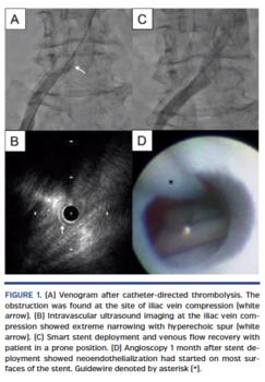 Venogram after catheter-directed thrombolysis