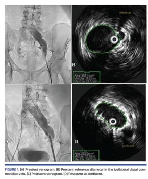 (A) Prestent venogram. (B) Prestent reference diameter in the ipsilateral distal common iliac vein. (C) Poststent venogram. (D) Poststent at confluent.
