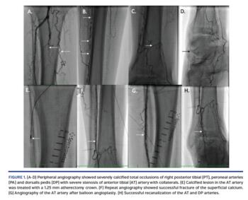 Peripheral angiography showed severely calcified total occlusions of right posterior tibial (PT), peroneal arteries (PA) and dorsalis pedis (DP) with severe stenosis of anterior tibial (AT) artery with collaterals.