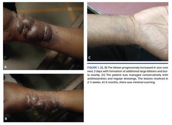 Sheath-Induced Sterile Abscesses