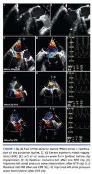Flail of the anterior leaflet. White arrow = calcification of the posterior leaflet.