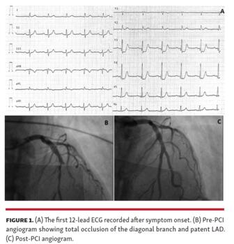 Figure 1. (A) The first 12-lead ECG recorded after symptom onset. (B) Pre-PCI angiogram showing total occlusion of the diagonal branch and patent LAD. (C) Post-PCI angiogram.