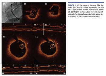 Haziness at the mid RCA (arrow).