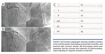 Coronary angiography showing complete occlusion of the mid left anterior descending, proximal left circumflex, and proximal right coronary arteries