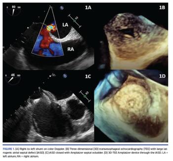 Right-to-left shunt on color Doppler. (B) Three-dimensional (3D) transesophageal echocardiography (TEE) with large iatrogenic atrial septal defect (iASD