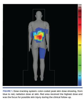 Dose-tracking system: color-coded peak skin dose showing, from blue to red, radiation dose at skin. Red area received the highest dose and was the focus for possible skin injury during the clinical follow-up.