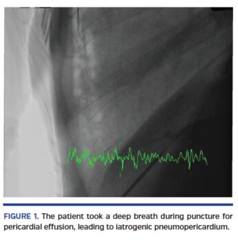 The patient took a deep breath during puncture for pericardial effusion, leading to iatrogenic pneumopericardium.