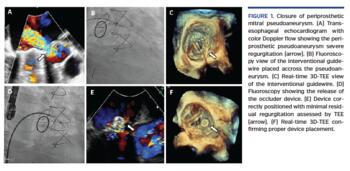 Closure of periprosthetic mitral pseudoaneurysm.