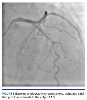 Baseline angiography showed a long, tight, and calcified proximal stenosis in the culprit LAD.