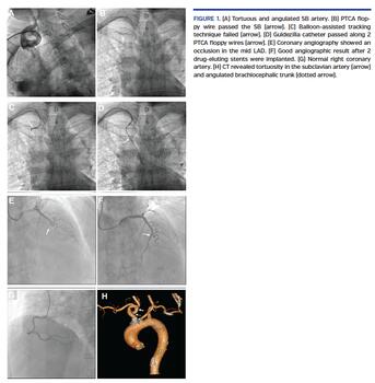 Tortuous and angulated SB artery