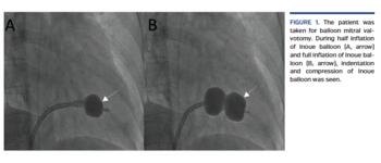 The patient was taken for balloon mitral valvotomy. During half inflation of Inoue balloon (A, arrow) and full inflation of Inoue balloon (B, arrow), indentation and compression of Inoue balloon was seen.