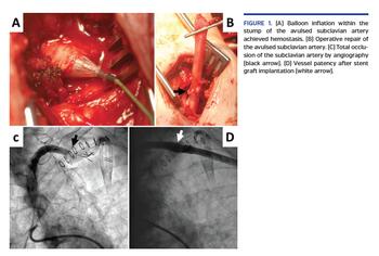 Balloon inflation within the stump of the avulsed subclavian artery achieved hemostasis.