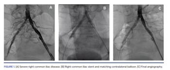 (A) Severe right common iliac disease. (B) Right common iliac stent and matching contralateral balloon. (C) Final angiography.