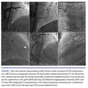 Left anterior descending (LAD) chronic total occlusion (CTO) characteristics.