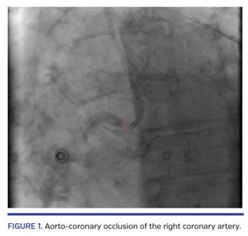 Aorto-coronary occlusion of the right coronary artery.