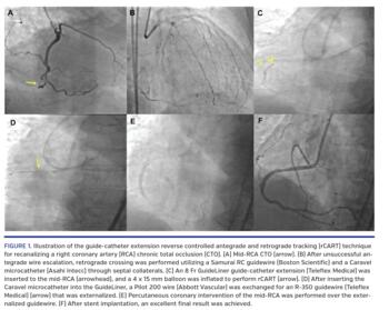 Illustration of the guide-catheter extension reverse controlled antegrade and retrograde tracking (rCART) technique for recanalizing a right coronary artery (RCA) chronic total occlusion (CTO).