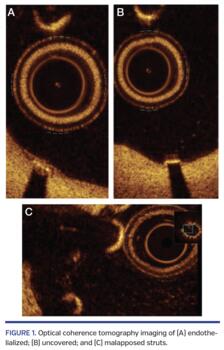 Optical coherence tomography imaging of (A) endothelialized; (B) uncovered; and (C) malapposed struts