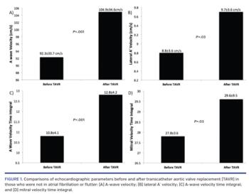 Comparisons of echocardiographic parameters before and after transcatheter aortic valve replacement (TAVR) in those who were not in atrial fibrillation or flutter: (A) A-wave velocity; (B) lateral A  velocity; (C) A-wave velocity time integral; and (D) mitral velocity time integral.