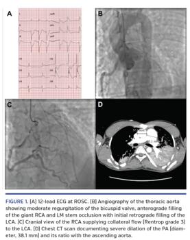 (A) 12-lead ECG at ROSC. (B) Angiography of the thoracic aorta showing moderate regurgitation of the bicuspid valve, anterograde filling of the giant RCA and LM stem occlusion with initial retrograde filling of the LCA. (C) Cranial view of the RCA supplying collateral flow (Rentrop grade 3) to the LCA. (D) Chest CT scan documenting severe dilation of the PA (diameter, 38.1 mm) and its ratio with the ascending aorta.
