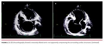Figure 1. (A, B) Echocardiography showed a massively dilated aortic root apparently compressing the surrounding cardiac structures. (continued)