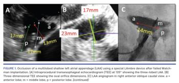 Occlusion of a multilobed shallow left atrial appendage (LAA) using a special LAmbre device after failed Watchman implantation. (A) Intraprocedural transesophageal echocardiogram (TEE) at 135  showing the three-lobed LAA. (B) Three-dimensional TEE showing the oval orifice dimensions. (C) LAA angiogram in right anterior oblique caudal view. a = anterior lobe; m = middle lobe; p = posterior lobe.