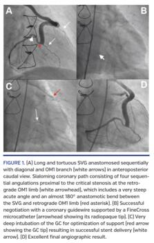 Long and tortuous SVG anastomosed sequentially with diagonal and OM1 branch (white arrows) in anteroposterior caudal view.