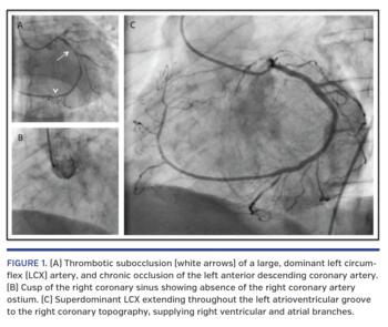 (A) Thrombotic subocclusion (white arrows) of a large, dominant left circumflex (LCX) artery, and chronic occlusion of the left anterior descending coronary artery. (B) Cusp of the right coronary sinus showing absence of the right coronary artery ostium. (C) Superdominant LCX extending throughout the left atrioventricular groove to the right coronary topography, supplying right ventricular and atrial branches.