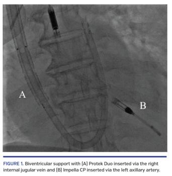 Biventricular support with (A) Protek Duo inserted via the right internal jugular vein and (B) Impella CP inserted via the left axillary artery.