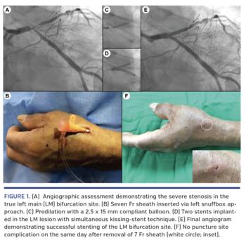 A) Angiographic assessment demonstrating the severe stenosis in the true left main (LM) bifurcation site. (B) Seven Fr sheath inserted via left snuffbox approach. (C) Predilation with a 2.5 x 15 mm compliant balloon. (D) Two stents implanted in the LM lesion with simultaneous kissing-stent technique. (E) Final angiogram demonstrating successful stenting of the LM bifurcation site. (F) No puncture site complication on the same day after removal of 7 Fr sheath (white circle; inset).