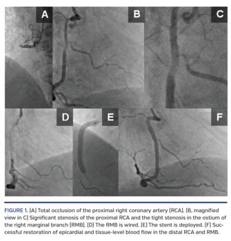 (A) Total occlusion of the proximal right coronary artery (RCA). (B, magnified view in C) Significant stenosis of the proximal RCA and the tight stenosis in the ostium of the right marginal branch (RMB). (D) The RMB is wired. (E) The stent is deployed. (F) Successful restoration of epicardial and tissue-level blood flow in the distal RCA and RMB.
