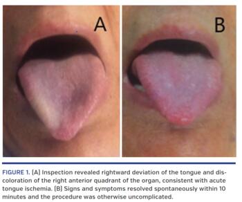 (A) Inspection revealed rightward deviation of the tongue and discoloration of the right anterior quadrant of the organ, consistent with acute tongue ischemia. (B) Signs and symptoms resolved spontaneously within 10 minutes and the procedure was otherwise uncomplicated.