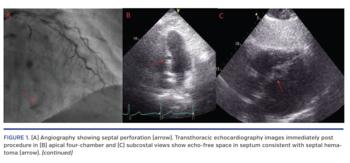 (A) Angiography showing septal perforation (arrow). Transthoracic echocardiography images immediately post procedure in (B) apical four-chamber and (C) subcostal views show echo-free space in septum consistent with septal hematoma (arrow). (continued)