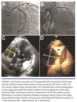 Severe stenosis of the proximal left circumflex (LCX) artery (arrow).