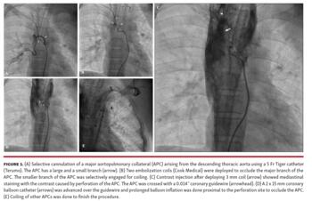 Figure 1. (A) Selective cannulation of a major aortopulmonary collateral (APC) arising from the descending thoracic aorta using a 5 Fr Tiger catheter (Terumo). The APC has a large and a small branch (arrow). (B) Two embolization coils (Cook Medical) were deployed to occlude the major branch of the APC. The smaller branch of the APC was selectively engaged for coiling. (C) Contrast injection after deploying 3 mm coil (arrow) showed mediastinal staining with the contrast caused by perforation of the APC. 